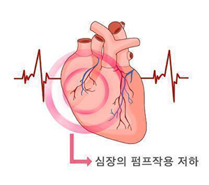 심부전
