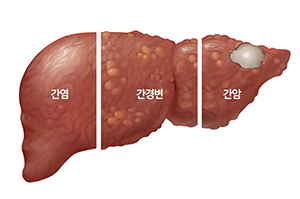간경화