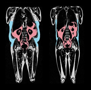 MRI로 본 내장지방과 피하지방. MRI 사진에서 내장지방(붉은색)과 피하지방(파란색)이 많은 사람(왼쪽)과 적은 사람의 차이가 확연히 드러나있다.